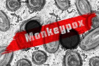 First case of monkeypox identified in Orange County